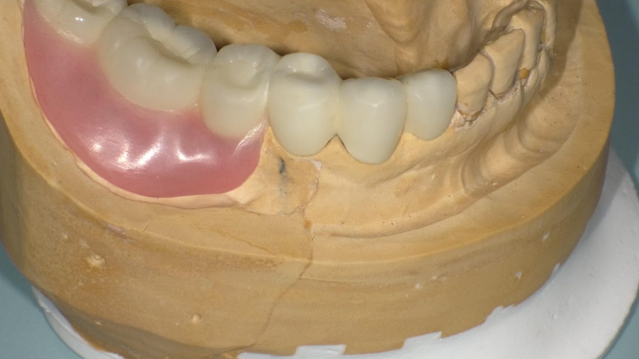金具の見えない目立たない入れ歯①　～リーゲルテレスコープ義歯～
