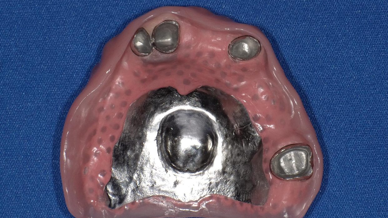 金具の見えない目立たない入れ歯③～レジリエンツテレスコープ義歯～