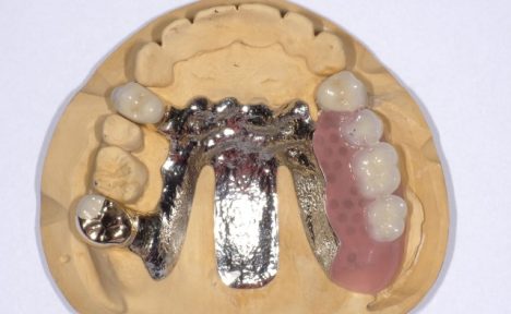 安定した噛み心地のコーヌステレスコープ義歯