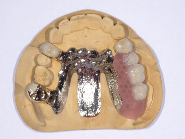 安定した噛み心地のコーヌステレスコープ義歯
