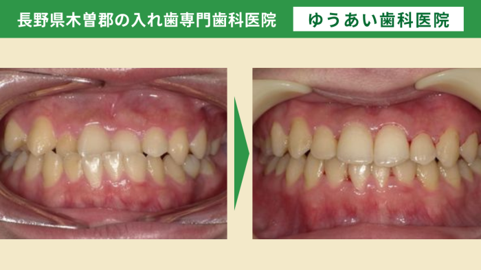 40代男性。自信を取り戻せた！前歯の歯並びをキレイにしたブラケットとワイヤーを使用した矯正治療