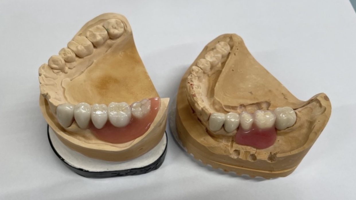 リーゲルテレスコープ義歯とコーヌステレスコープ義歯の違い