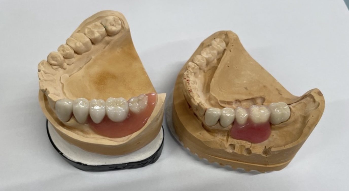 リーゲルテレスコープ義歯とコーヌステレスコープ義歯の違い