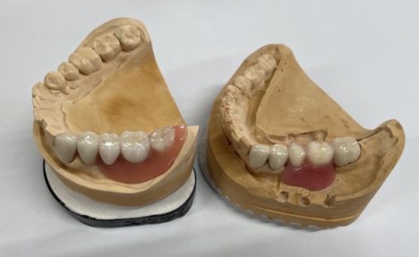 リーゲルテレスコープ義歯とコーヌステレスコープ義歯の違い