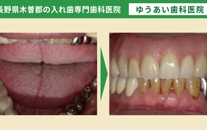 70代男性。お口全体がボロボロで銀歯だった8年前かと今後の入れ歯治療