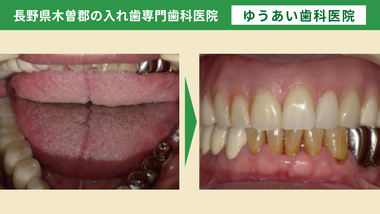 70代男性。お口全体がボロボロで銀歯だった8年前かと今後の入れ歯治療