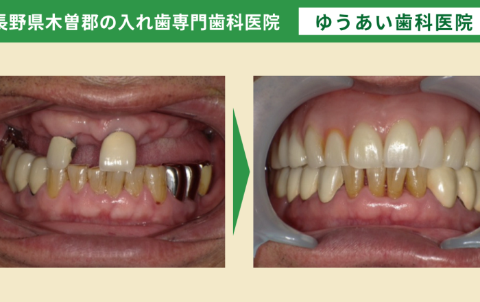 60代男性。複数年かけてドイツ式入れ歯で治療した症例