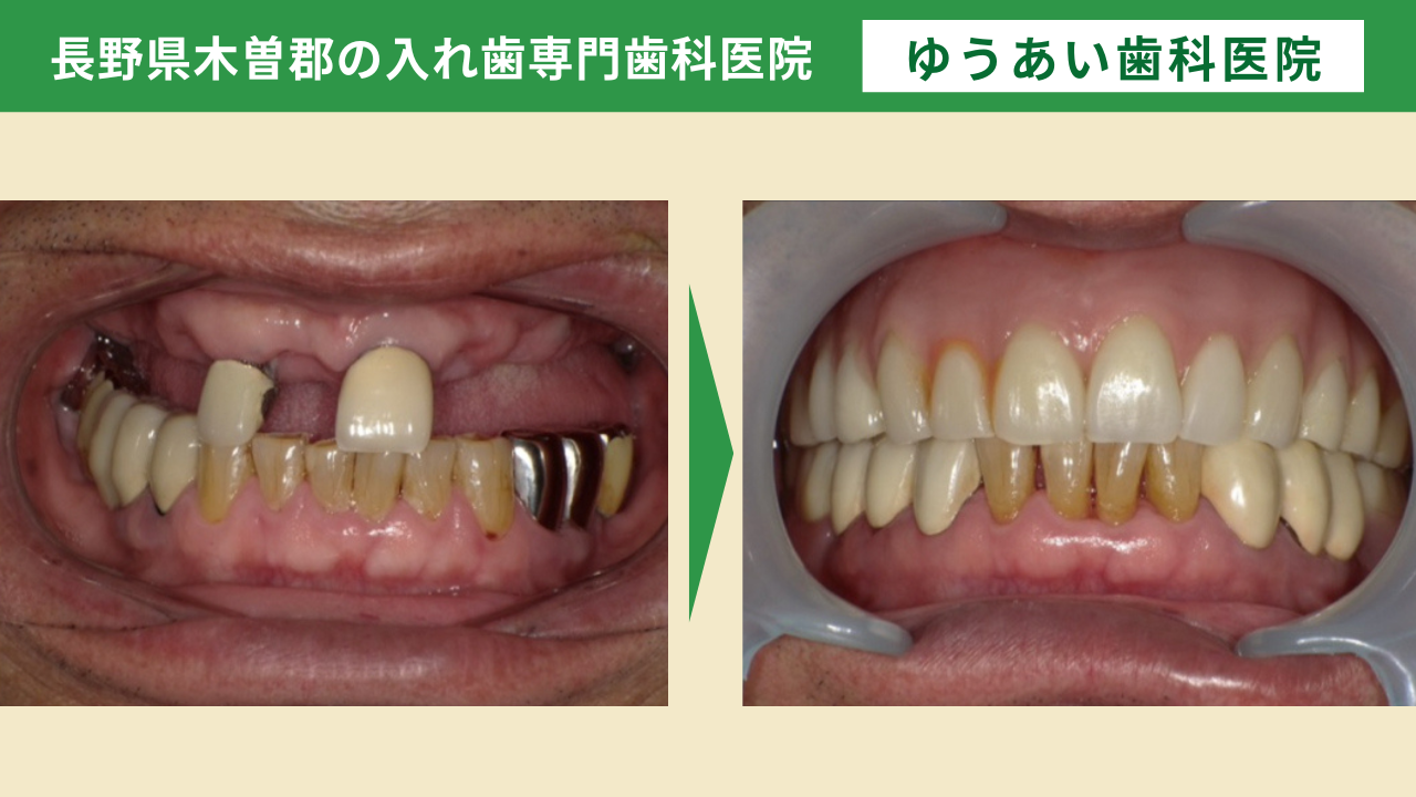60代男性。複数年かけてドイツ式入れ歯で治療した症例