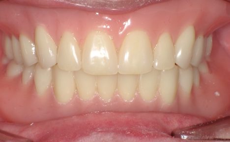 ドイツ式総入れ歯