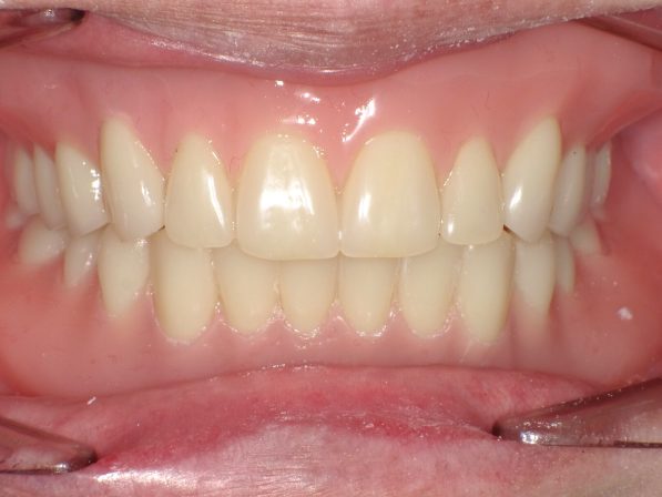 ドイツ式総入れ歯（シュトラックデンチャー）