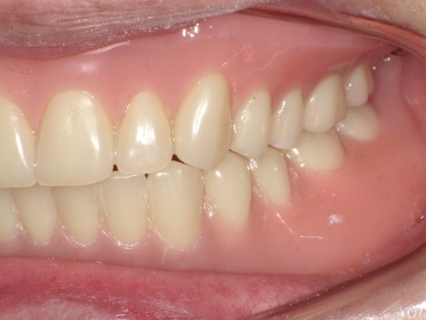 ドイツ式総入れ歯（シュトラックデンチャー）3