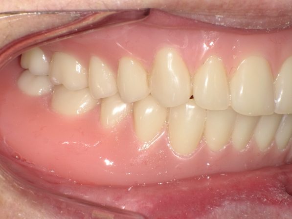 ドイツ式総入れ歯（シュトラックデンチャー）2